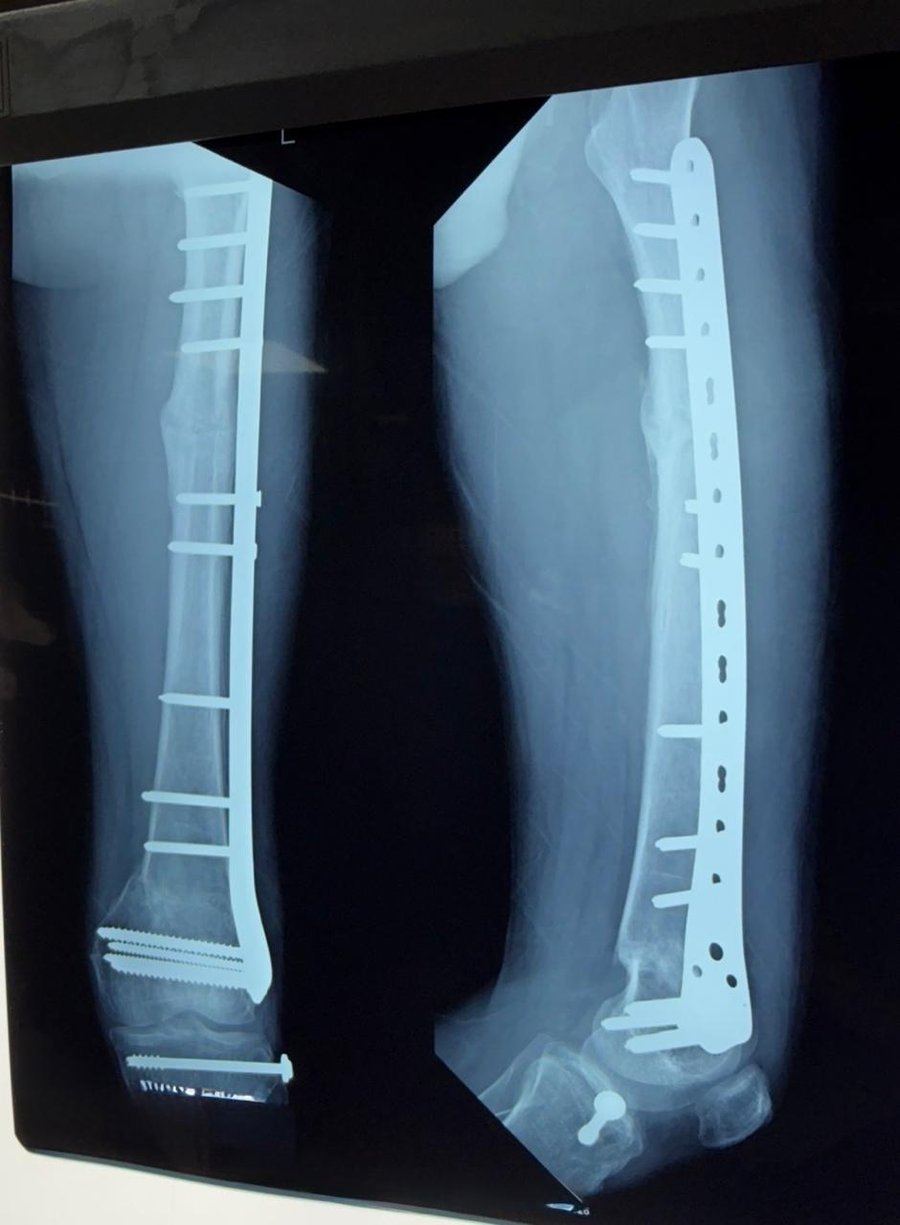 Post-operative X-ray showing surgical fixation of a long-bone trauma fracture